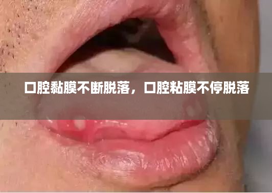 口腔黏膜不断脱落，口腔粘膜不停脱落 